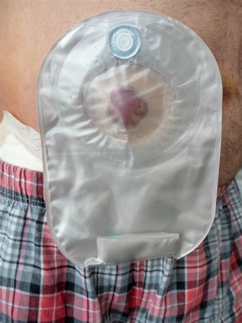 what to do when ostomy bag keeps leaking|20 Failproof Tips To Prevent Your Stoma From Leaking